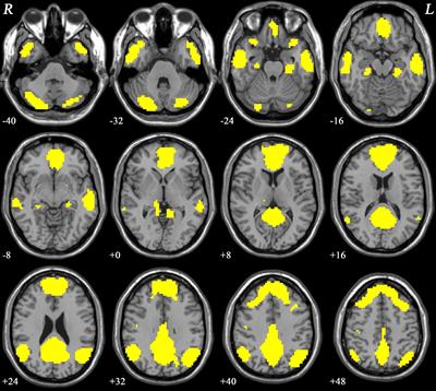 Abnormal network homogeneity of default-mode network and its relationships with clinical symptoms in antipsychotic-naïve first-diagnosis schizophrenia